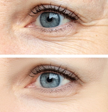 Lines under eyes before and after Botox in Albuquerque