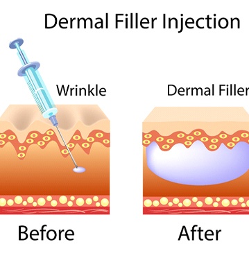 Illustration showing the skin before and after Juvederm dermal fillers in Albequerque