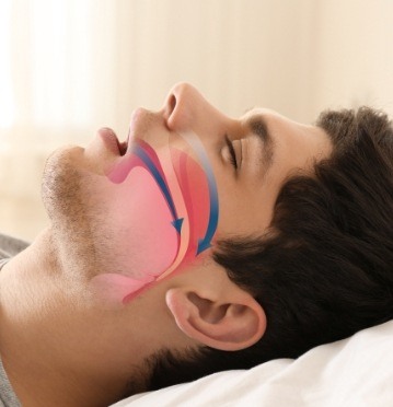 Sleeping man with animation of airway over cheek