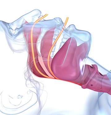 Illustration showing obstructed airway during sleep apnea