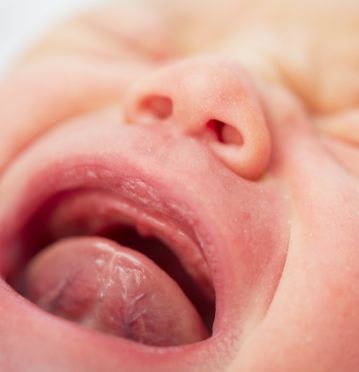 Baby crying before lip and tongue tie treatment