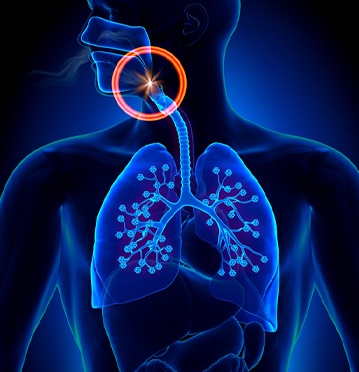Illustration of airway during obstructive sleep apnea