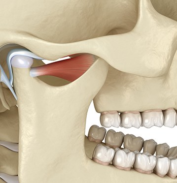 Animated jaw suffering from TMJ disorder